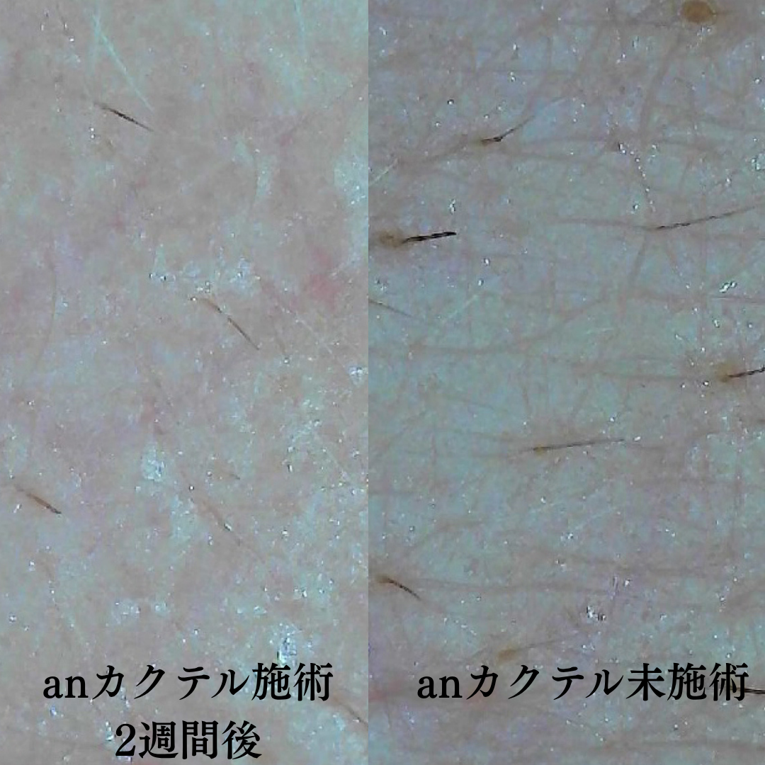 肌育製剤を半顔に注入して2週間後にマイクロスコープで左右の肌を比較した画像