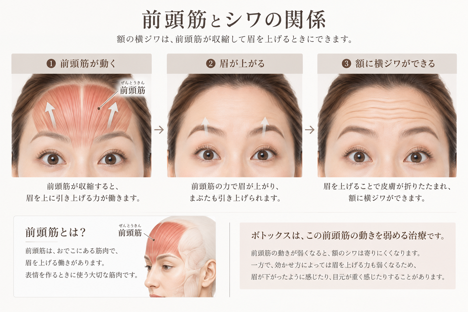 前頭筋の収縮によって眉が上がり、額に横ジワができる仕組み