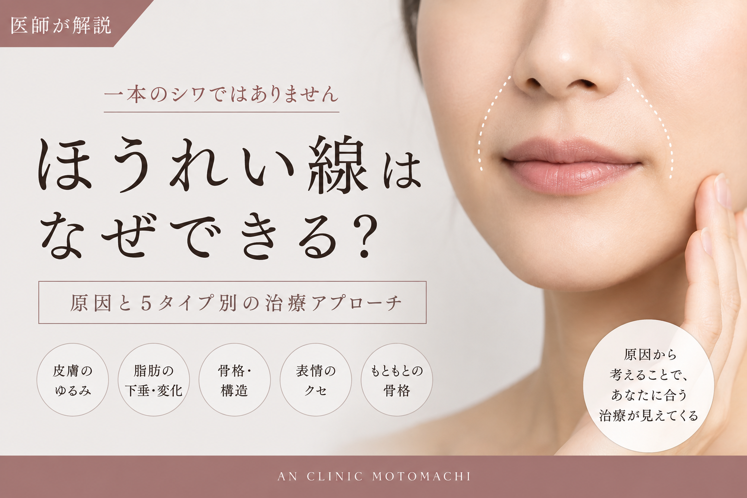 ほうれい線ができる原因と5タイプ別の治療アプローチを示したイメージ