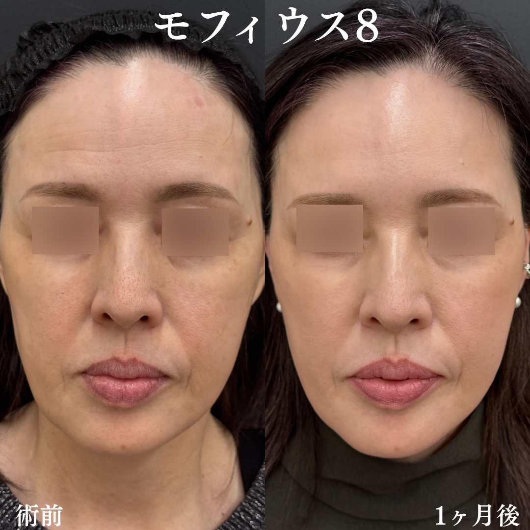 モフィウス8施術前と施術1か月後の症例写真