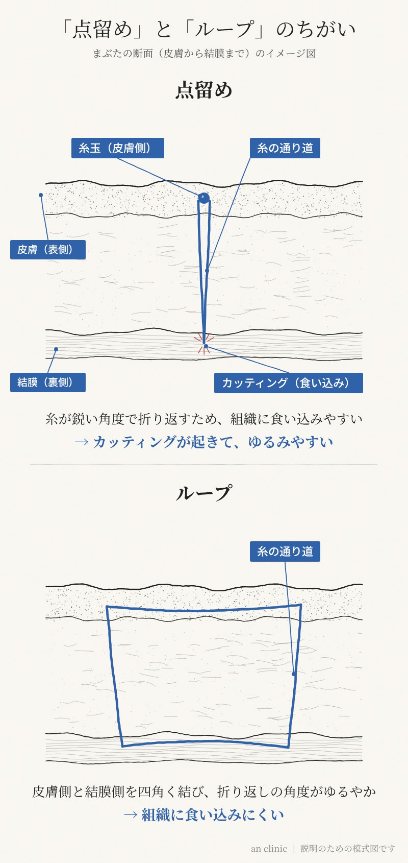 埋没法の点留めとループのちがい。点留めは糸が鋭い角度で折り返し、皮膚側に糸玉がくる。ループは皮膚側と結膜側を四角く結ぶ